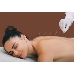Acupuntura